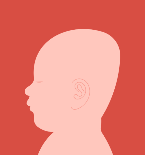 An abnormally shaped head is the first sign of craniosynostosis.