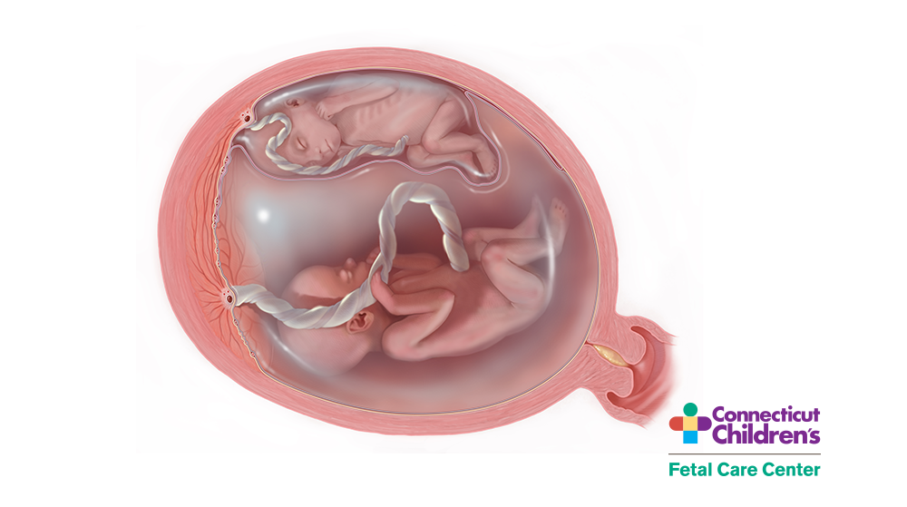 Medical Illustration of Twin-Twin Transfusion Syndrome