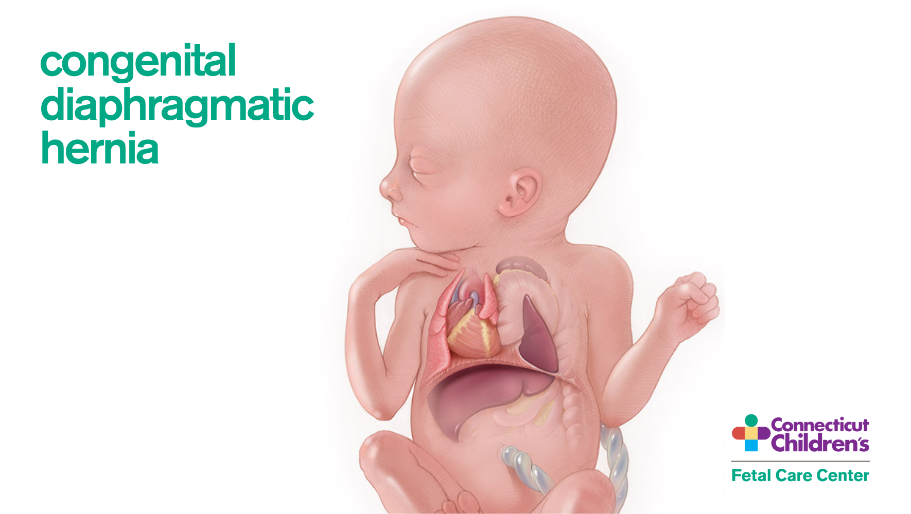 Congenital Diaphragmatic Hernia Illustration