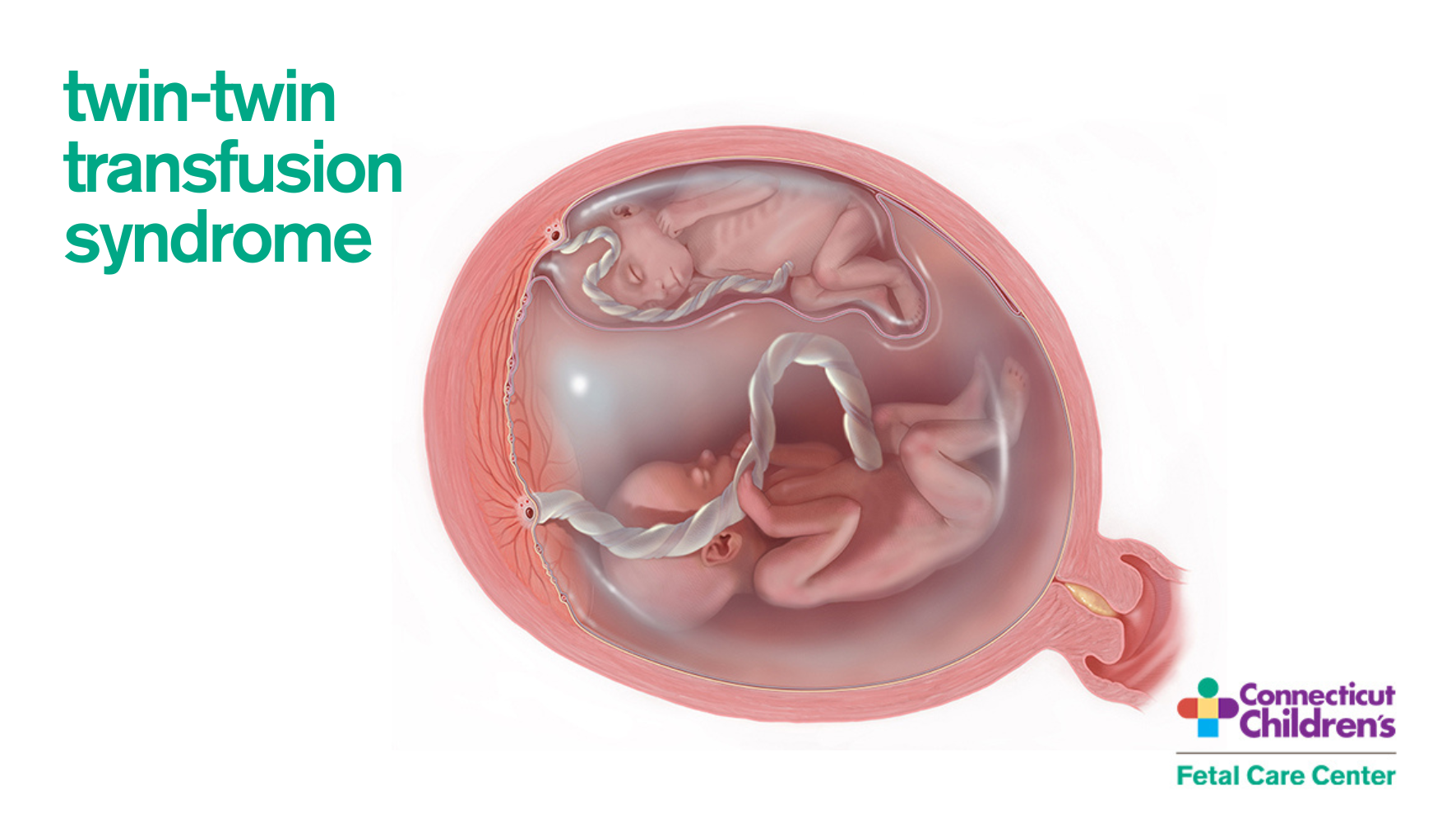 twin twin transfusion syndrome illustration