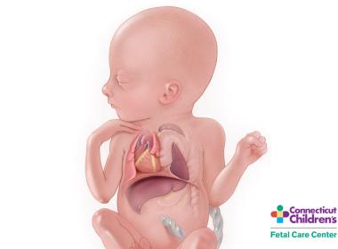 Medical illustration of congenital diaphragmatic hernia