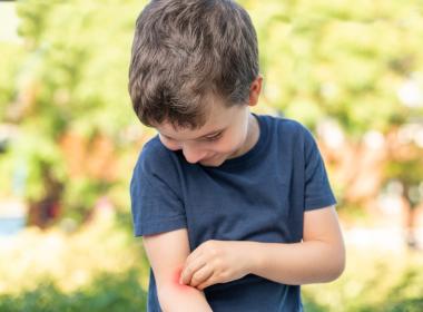 Young boy itching mosquito bite on arm. 