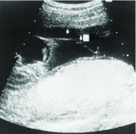 An ultrasound 