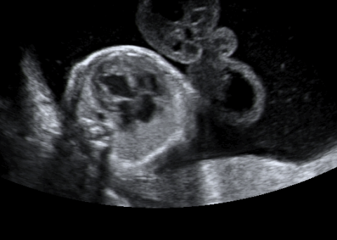 An ultrasound 