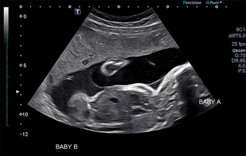 An ultrasound 