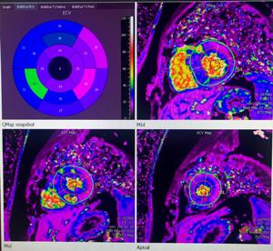 Cardiac MRI 