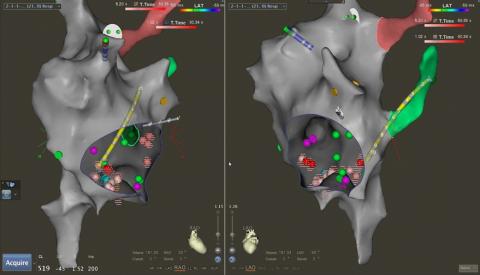 Medical imaging from an electrophysiology procedure 