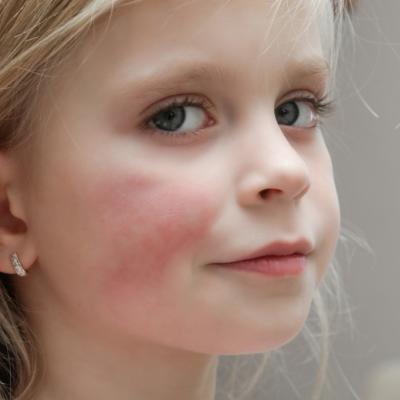 Young girl with red rash on right cheek